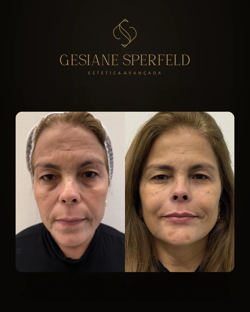 Antes e depois de harmonização facial — Dra. Gesiane Sperfeld