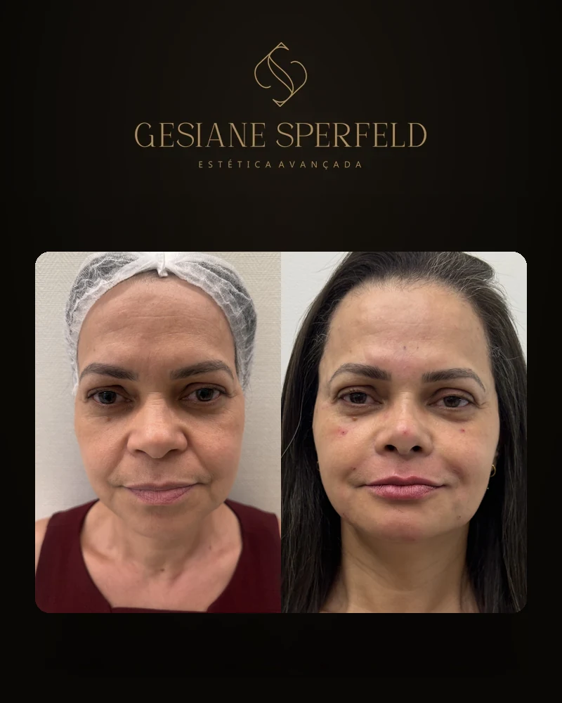 Antes e depois de harmonização facial — Dra. Gesiane Sperfeld