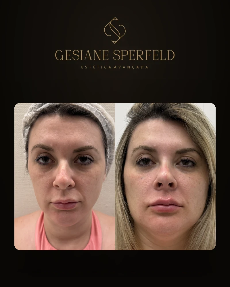 Antes e depois de harmonização facial — Dra. Gesiane Sperfeld