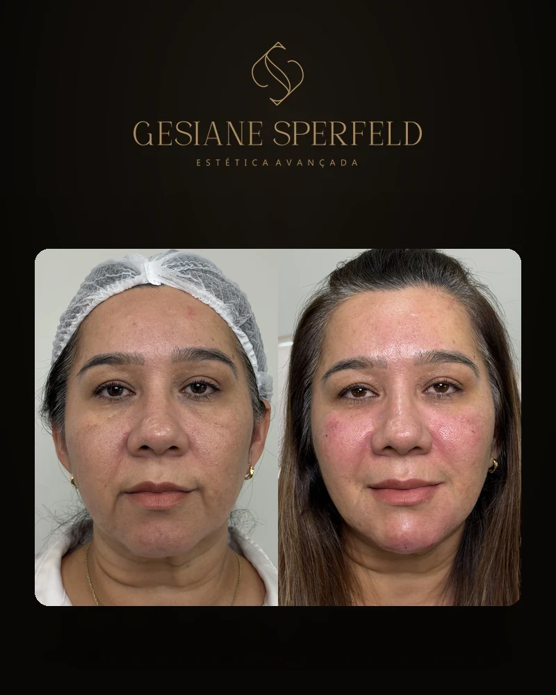Antes e depois de harmonização facial — Dra. Gesiane Sperfeld