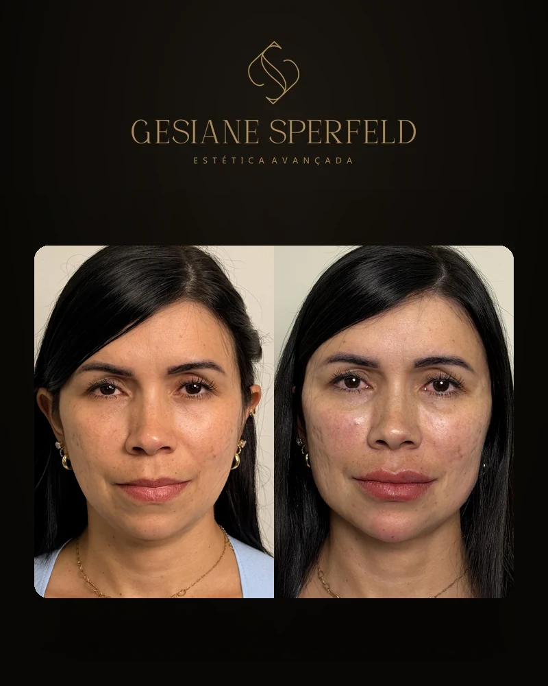 Antes e depois de harmonização facial — Dra. Gesiane Sperfeld