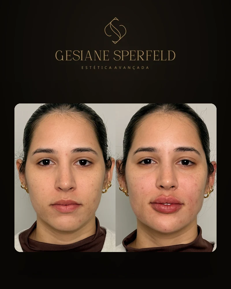 Antes e depois de harmonização facial — Dra. Gesiane Sperfeld