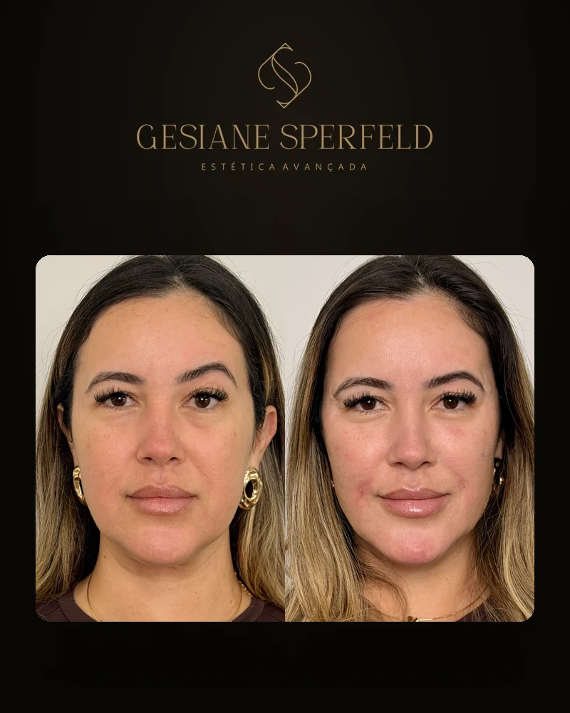 Antes e depois de harmonização facial — Dra. Gesiane Sperfeld