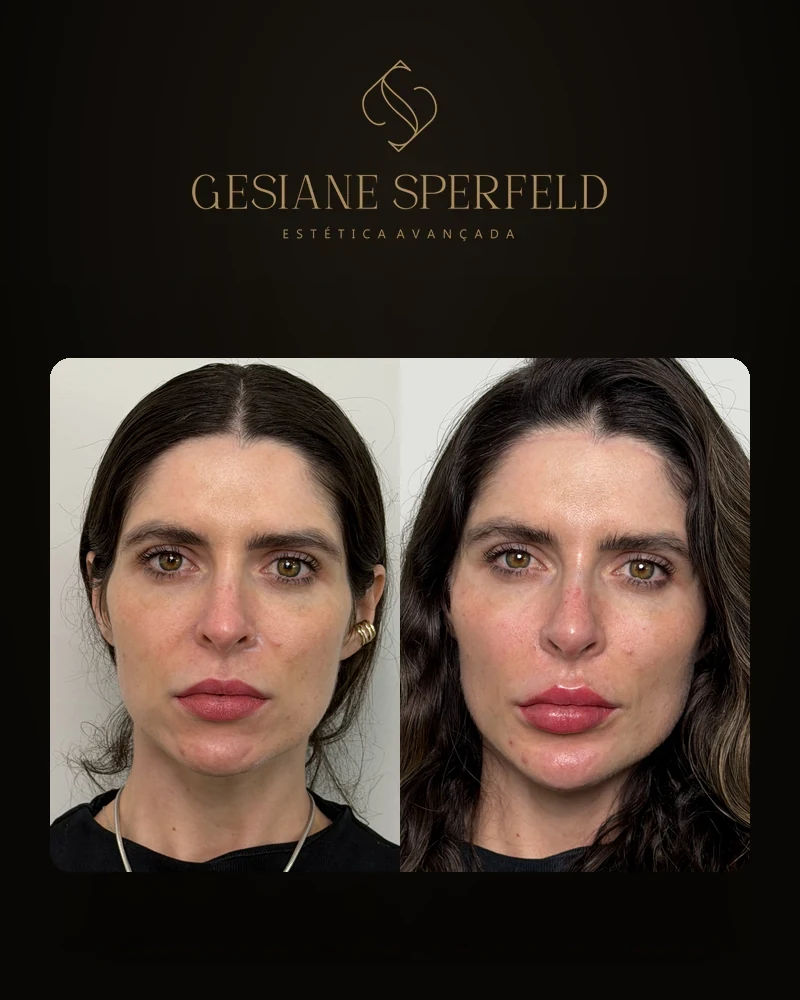 Antes e depois de harmonização facial — Dra. Gesiane Sperfeld