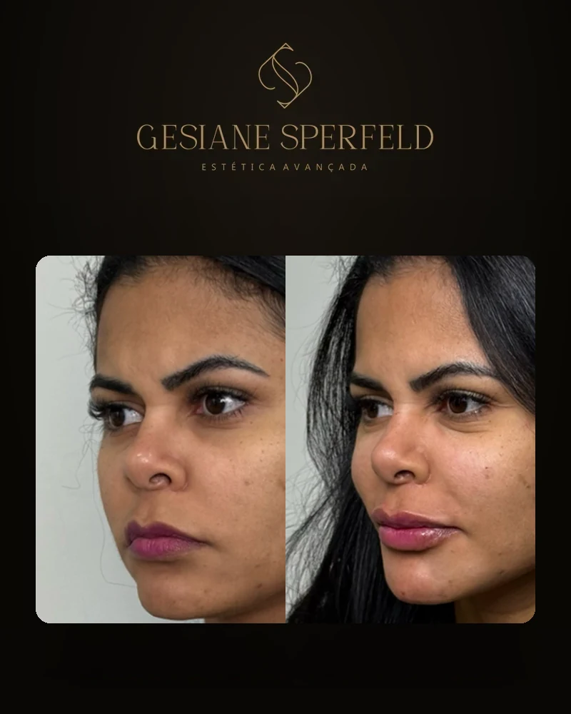 Antes e depois de harmonização facial — Dra. Gesiane Sperfeld