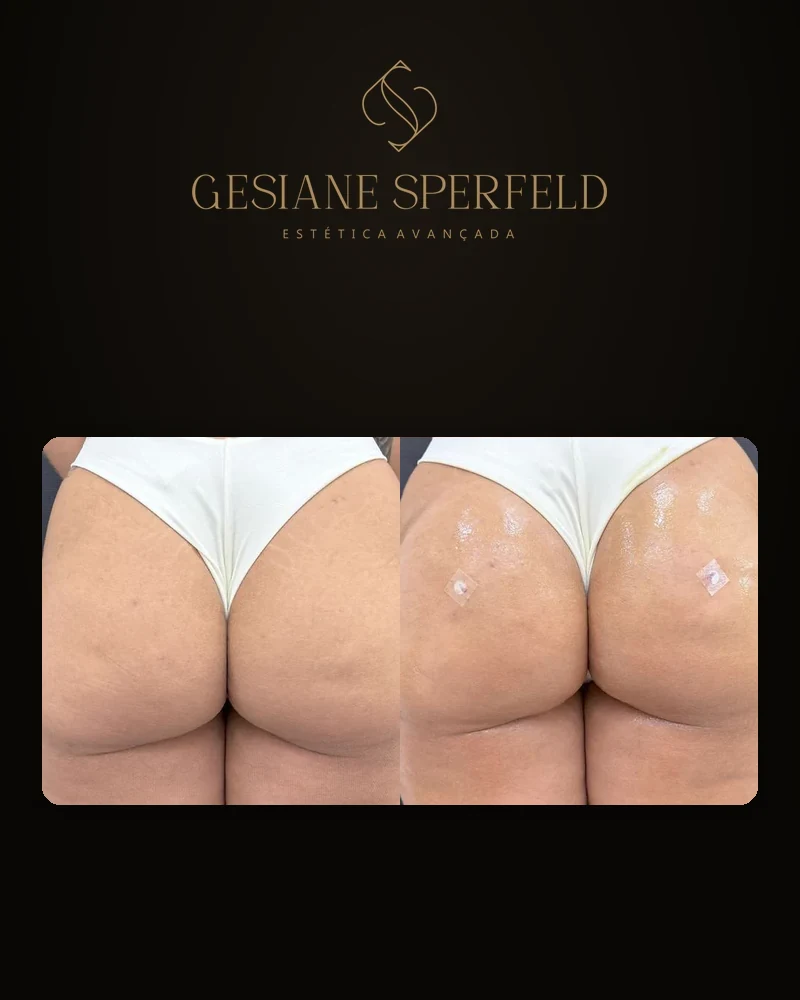 Antes e depois de harmonização de glúteos — Dra. Gesiane Sperfeld
