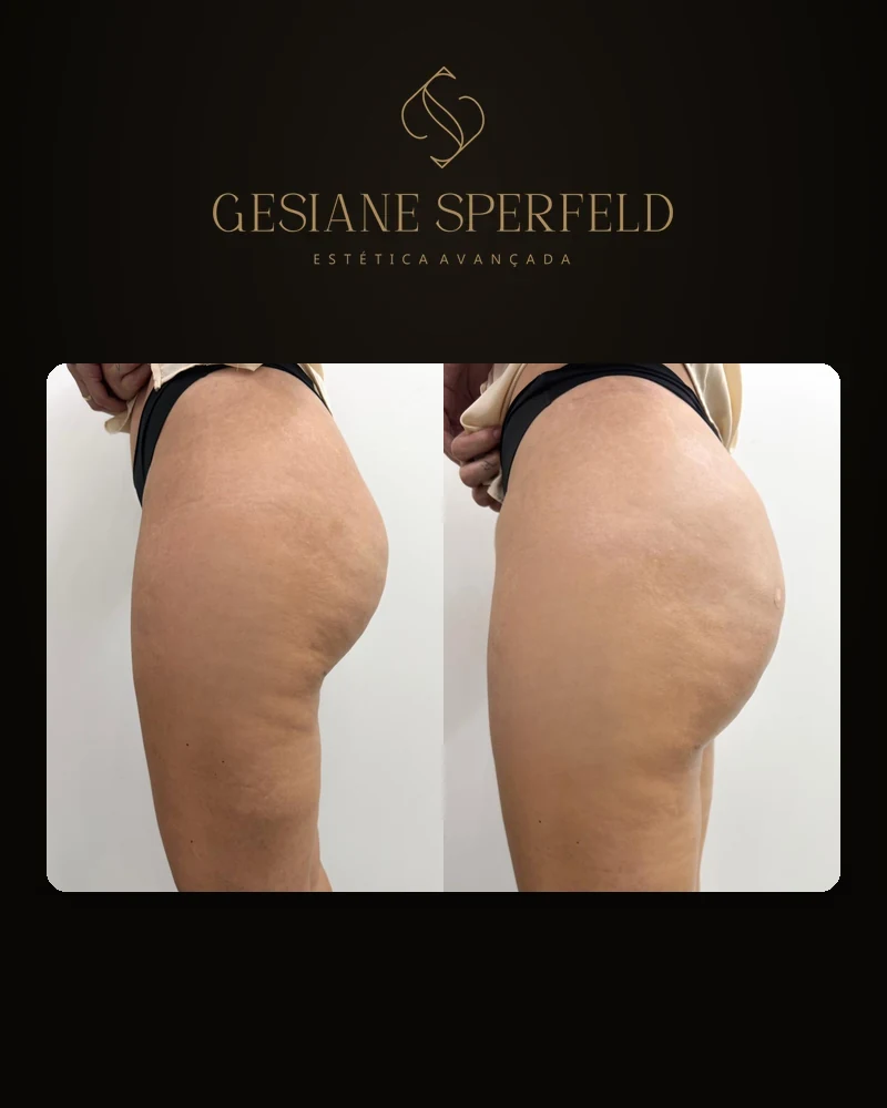 Antes e depois de harmonização de glúteos — Dra. Gesiane Sperfeld