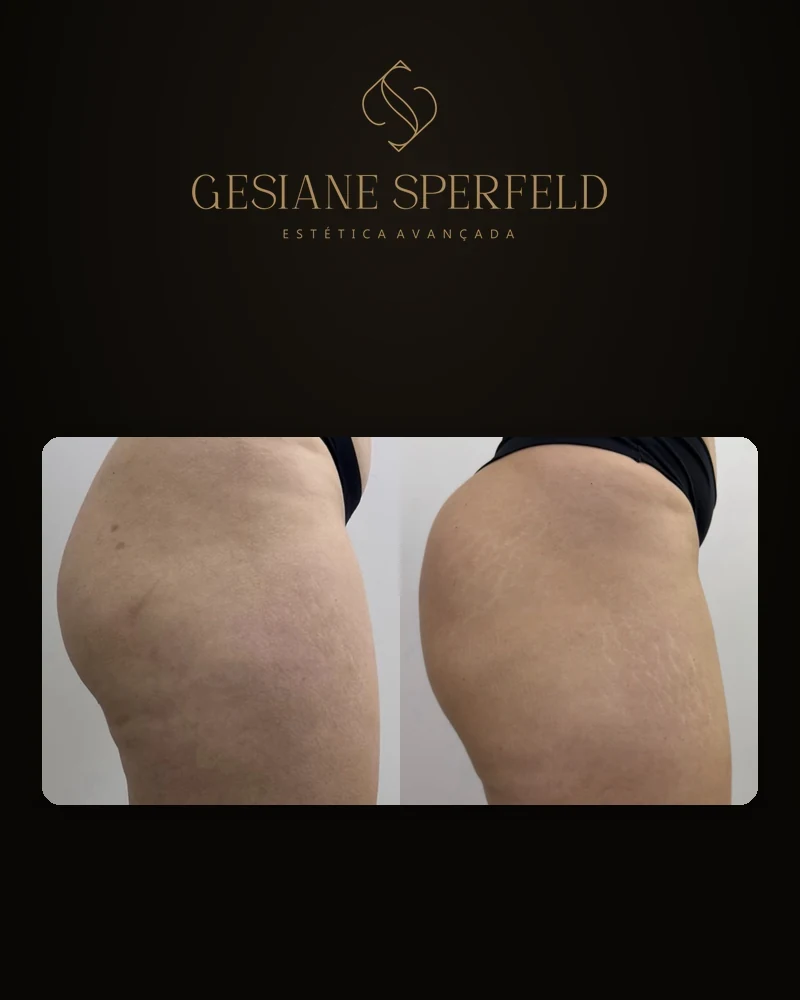 Antes e depois de harmonização de glúteos — Dra. Gesiane Sperfeld