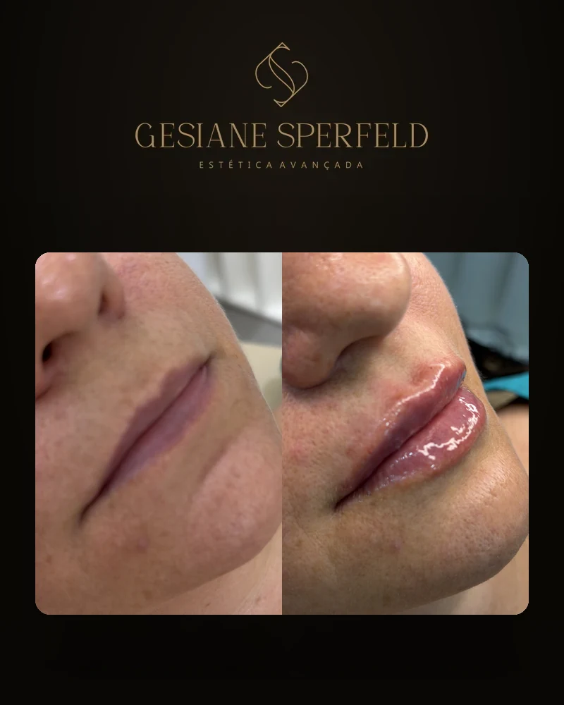 Antes e depois de preenchimento labial — Dra. Gesiane Sperfeld
