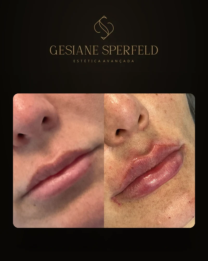 Antes e depois de preenchimento labial — Dra. Gesiane Sperfeld